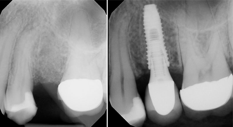 dental implants