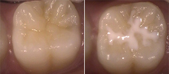 sealants before and after