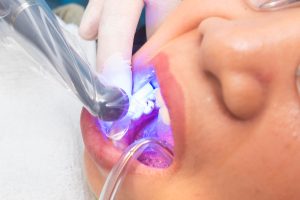 Dental bonding treatment in Chula Vista, CA
